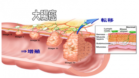 大腸がん　転移